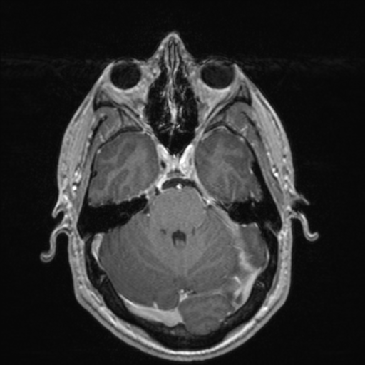File:Colloid cyst (Radiopaedia 44510-48181 Axial T1 C+ 62).png