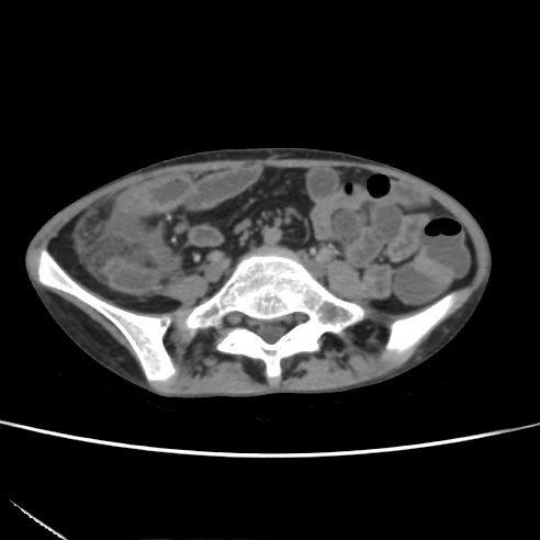 File:Colocolic fistula - Crohn disease (Radiopaedia 57063-63955 A 56).jpg