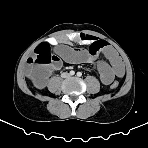 File:Colocolic intussusception due to large lipoma (Radiopaedia 68773-78482 A 116).jpg