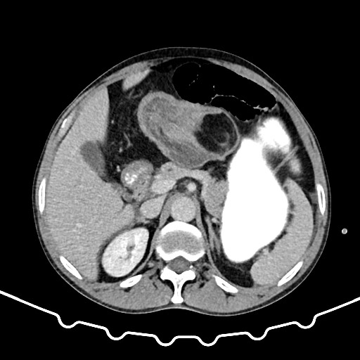 Colocolic intussusception due to large lipoma (Radiopaedia 68773-78482 A 47).jpg