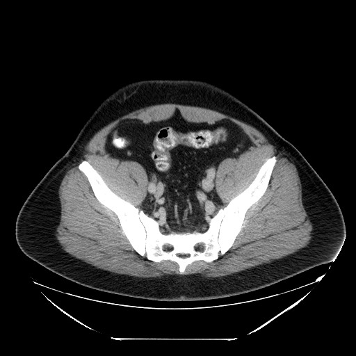 Colocolic intussusception due to lipoma (Radiopaedia 73712-84508 A 95).jpg