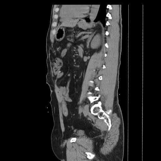 File:Colocutaneous fistula in Crohn's disease (Radiopaedia 29586-30093 C 34).jpg