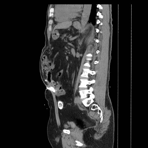 Colocutaneous fistula in Crohn's disease (Radiopaedia 29586-30093 F 24).jpg