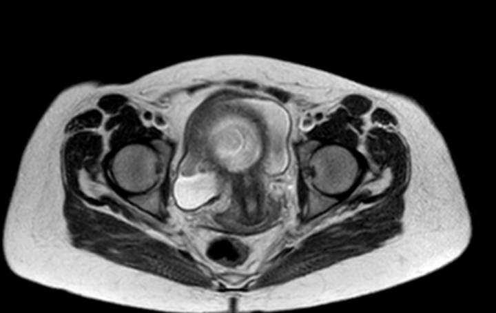 Colon adenocarcinoma with Krukenberg tumors, advanced pregnancy (Radiopaedia 67279-76645 Axial T2 9).jpg