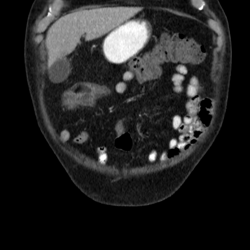 File:Colon cancer with duodenal invasion (Radiopaedia 16278-15958 B 10).jpg
