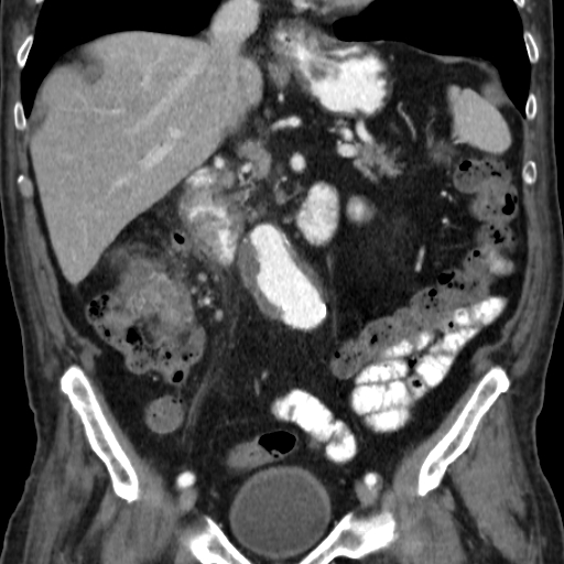 File:Colon cancer with duodenal invasion (Radiopaedia 16278-15958 B 30).jpg