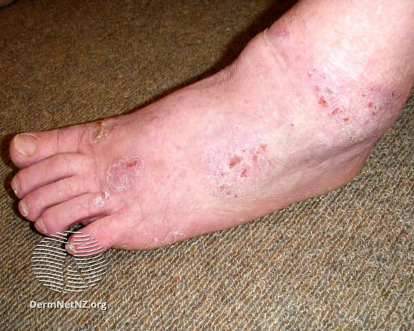 File:Contact dermatitis due to neoprene and diethylthiourea allergy (DermNet NZ dermatitis-diethylthiourea-allergy3).jpg