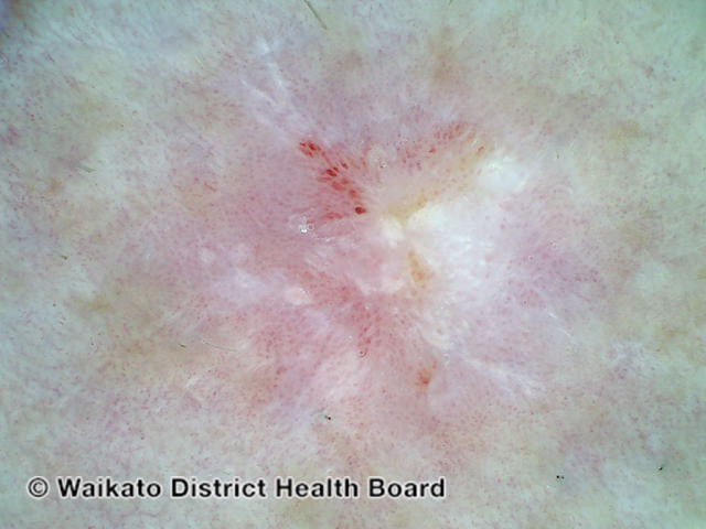 File:Intraepidermal carcinoma, polarised dermoscopy view (DermNet NZ 155843-v2).jpg