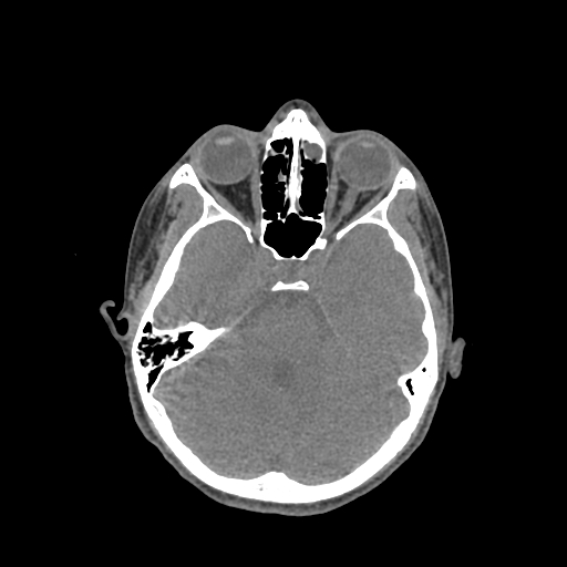Nasal pyogenic granuloma (lobular capillary hemangioma) (Radiopaedia 85536-101244 Axial non-contrast 96).jpg