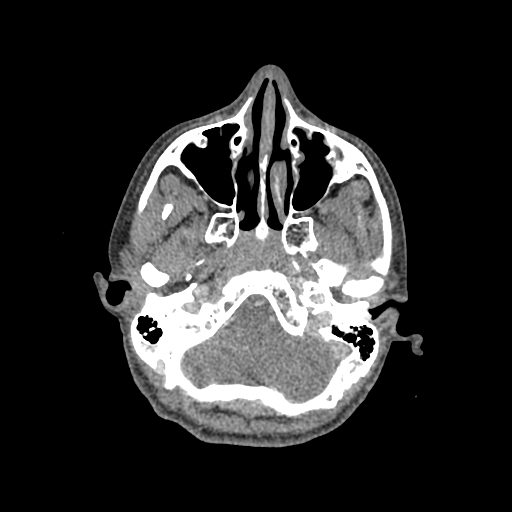 File:Nasal pyogenic granuloma (lobular capillary hemangioma) (Radiopaedia 85536-101244 C 69).jpg