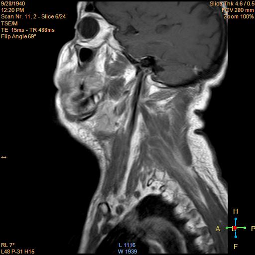File:Nasopharyngeal carcinoma (Radiopaedia 22375-22403 Sagittal T1 C+ 3).jpg