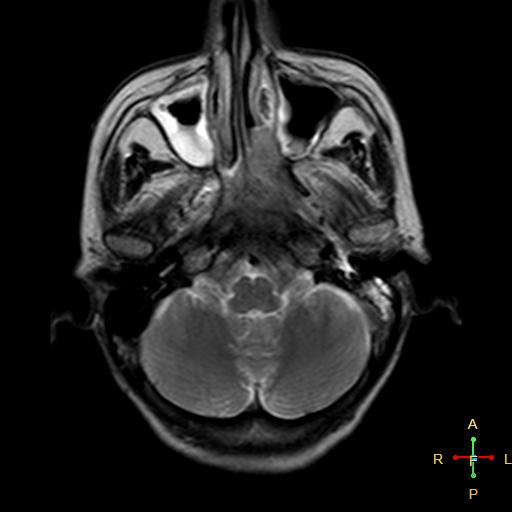 File:Nasopharyngeal carcinoma infiltrating the clivus (Radiopaedia 25229-25481 Axial T2 5).jpg