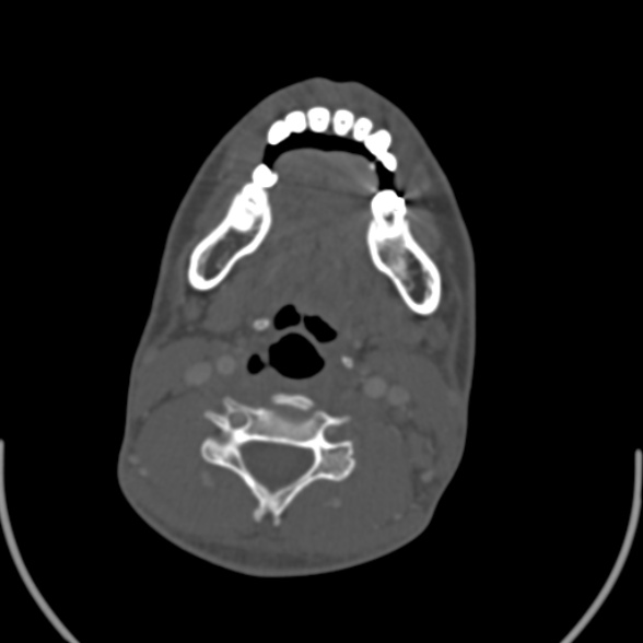 Nasopharyngeal carcinoma with skull base invasion (Radiopaedia 53415-59705 Axial bone window 120).jpg