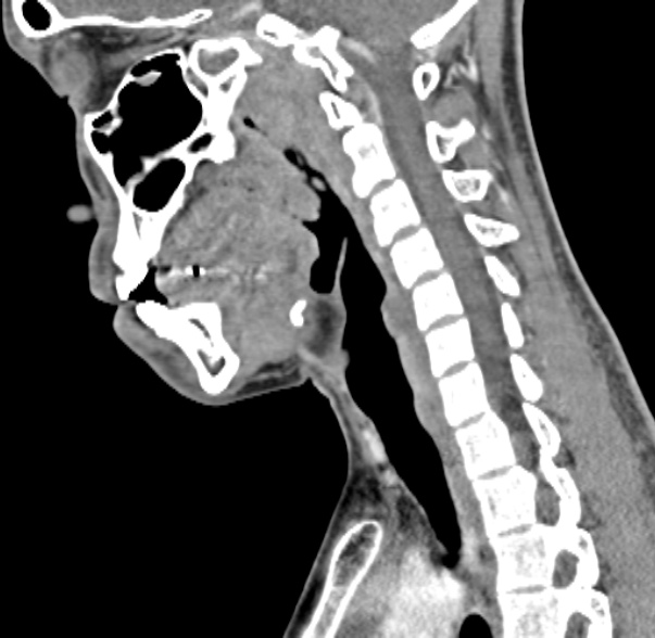 Nasopharyngeal carcinoma with skull base invasion (Radiopaedia 53415-59705 C 32).jpg