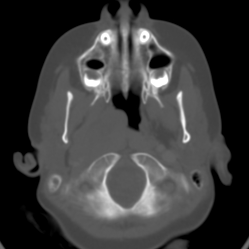 File:Nasopharyngeal rhabdomyosarcoma (Radiopaedia 23417-23491 Axial bone window 4).jpg