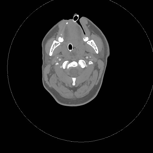 Neck CT angiogram (intraosseous vascular access) (Radiopaedia 55481-61945 B 221).jpg