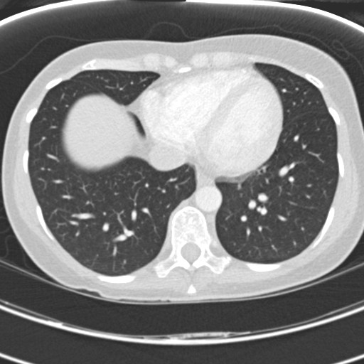 Necrobiotic pulmonary nodules - Crohn disease (Radiopaedia 20723-20631 Axial lung window 104).jpg