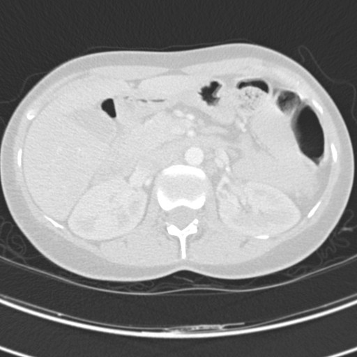 Necrobiotic pulmonary nodules - Crohn disease (Radiopaedia 20723-20631 Axial lung window 155).jpg