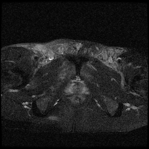 File:Necrotizing epididymo-orchitis with intra-testicular abscess (Radiopaedia 29397-29860 Axial T2 fat sat 6).jpg