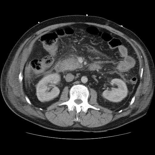 File:Necrotizing pancreatitis - acute necrotic collection maturing into walled-off pancreatic necrosis (Radiopaedia 9602-10249 A 8).jpg