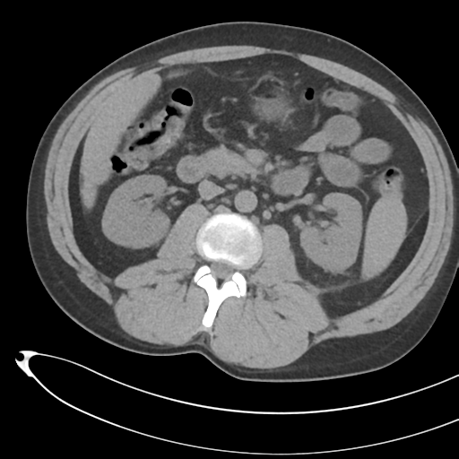 File:Necrotizing pancreatitis with acute necrotic collections (Radiopaedia 38829-41012 Axial non-contrast 38).png