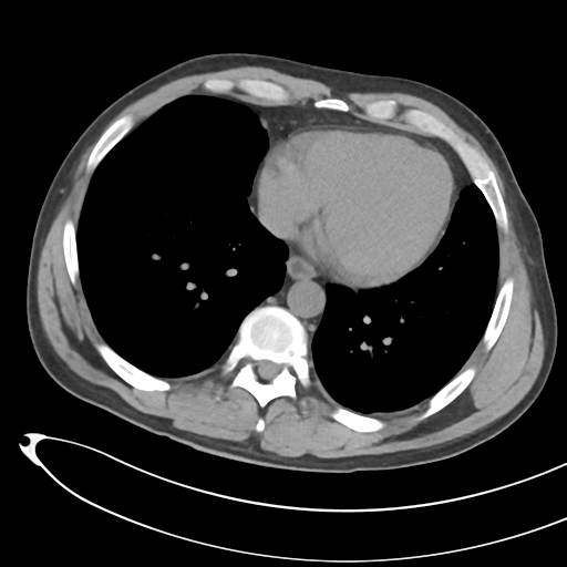 File:Necrotizing pancreatitis with acute necrotic collections (Radiopaedia 38829-41012 Axial non-contrast 4).png