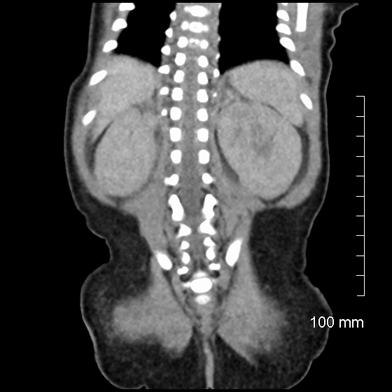 File:Neonatal neuroblastoma (Radiopaedia 56651-63438 Coronal non-contrast 40).jpg