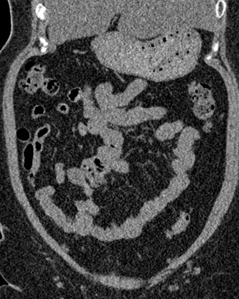 File:Nephrostomy for urosepsis (Radiopaedia 26180-26330 non-contrast 27).jpg
