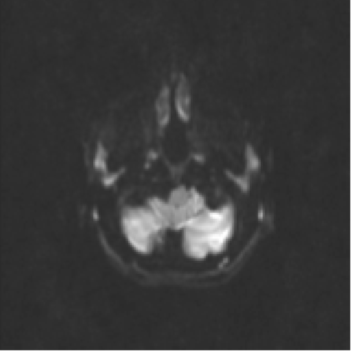 Neurenteric cyst (Radiopaedia 58641-65837 Axial DWI 39).png