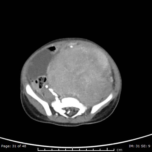 File:Neuroblastoma (Radiopaedia 41472-44355 A 31).jpg