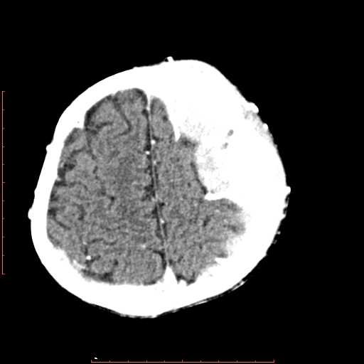 File:Neuroblastoma skull metastasis (Radiopaedia 56053-62683 Axial +Contrast 14).jpg