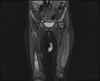 File:Neuroblastoma with bone metastases (Radiopaedia 67080-76414 Coronal STIR 9).jpg