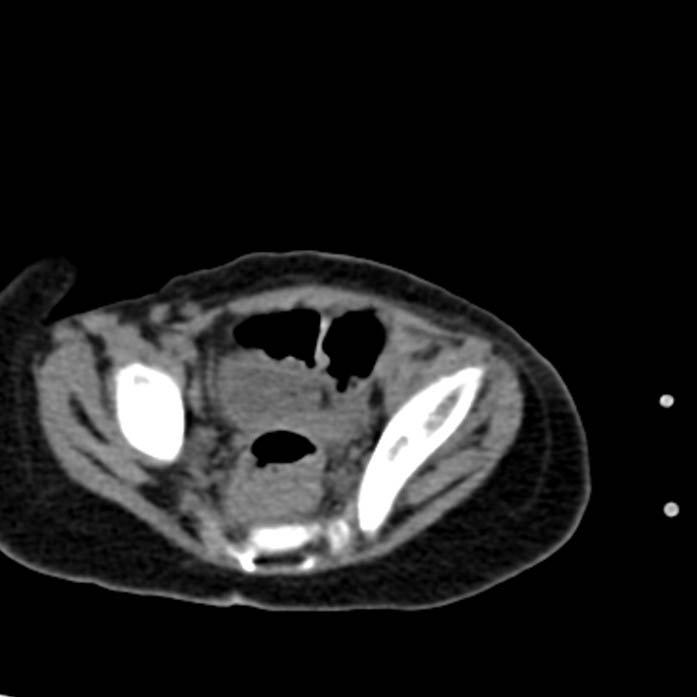 Neuroblastoma with skull metastases (Radiopaedia 30326-30960 Axial non-contrast 53).jpg