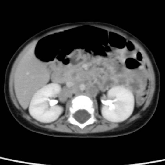 Neuroblastoma with skull metastases (Radiopaedia 30326-30960 C 28).jpg