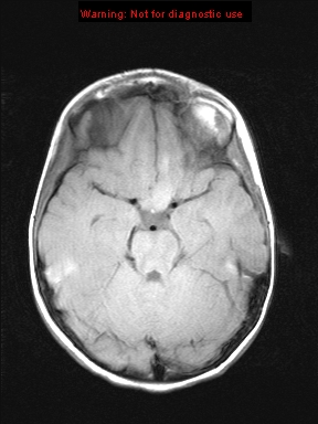 File:Neurofibromatosis type 1 with optic nerve glioma (Radiopaedia 16288-15965 Axial T1 16).jpg