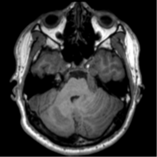 File:Neurofibromatosis type 2 (Radiopaedia 44936-48838 Axial T1 34).png