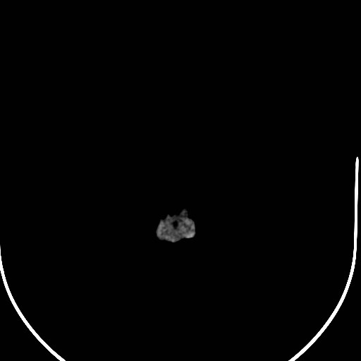 Neurofibromatosis type 2 (Radiopaedia 79097-92047 Axial non-contrast 66).jpg