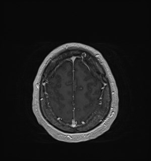 Neurofibromatosis type 2 (Radiopaedia 79097-92049 Axial T1 C+ 168).jpg