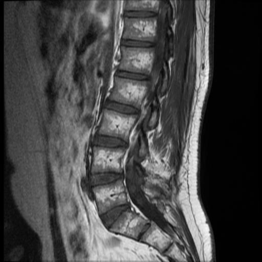File:Neurofibromatosis type 2 (spinal manifestations) (Radiopaedia 53943-60070 F 9).png
