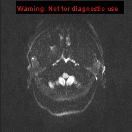 File:Neuroglial cyst (Radiopaedia 10713-11184 Axial DWI 44).jpg