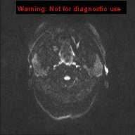 File:Neuroglial cyst (Radiopaedia 10713-11184 Axial DWI 45).jpg