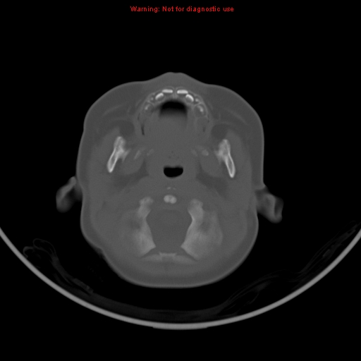 File:Non-accidental injury - bilateral subdural with acute blood (Radiopaedia 10236-10765 Axial bone window 2).jpg