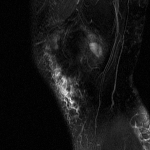 File:Non-displaced patella fracture (Radiopaedia 15932-15582 Sagittal T2 fat sat 1).jpg