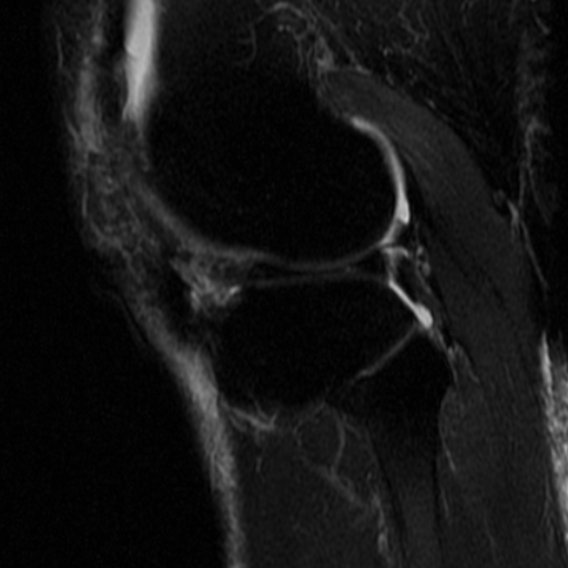 File:Non-displaced patella fracture (Radiopaedia 15932-15582 Sagittal T2 fat sat 15).jpg