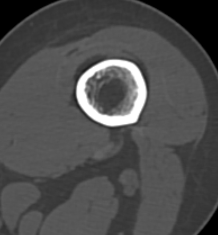 Non-ossifying fibroma - femur (Radiopaedia 82786-97042 Axial bone window 32).jpg