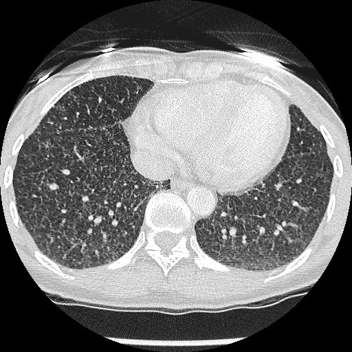 File:Non-small cell lung cancer with miliary metastases (Radiopaedia 23995-24193 Axial lung window 18).jpg