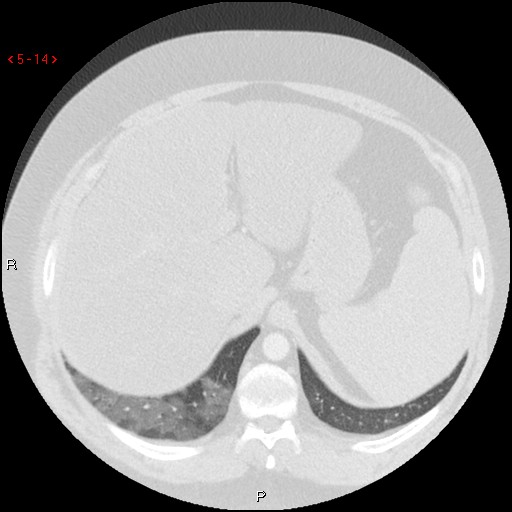 File:Non-specific interstitial pneumonitis (Radiopaedia 27044-27222 Axial lung window 5).jpg
