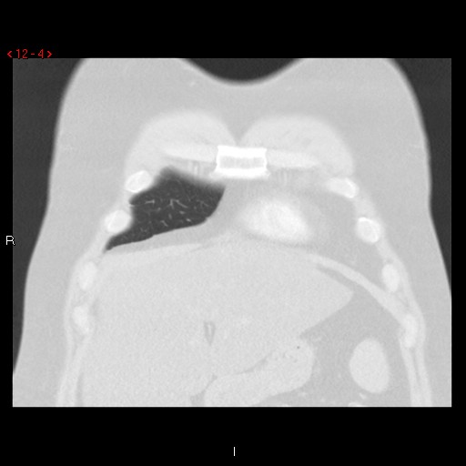 File:Non-specific interstitial pneumonitis (Radiopaedia 27044-27222 Coronal lung window 4).jpg