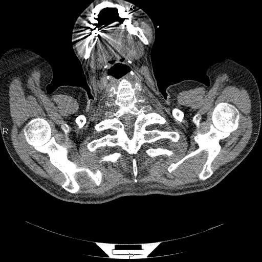 File:Non Hodgkin lymphoma in a patient with ankylosing spondylitis (Radiopaedia 84323-99624 Axial non-contrast 3).jpg