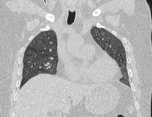 Non specific interstitial pneumonia (NSIP) (Radiopaedia 89725-106798 Coronal lung window 32).jpg
